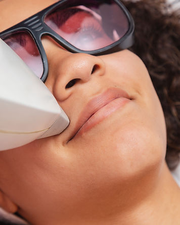 Traitement laser sécuritaire et adapté aux peaux foncées effectué par une infirmière esthétique certifiée.
