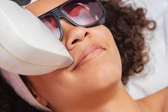 Upper Lip Laser Hair Removal