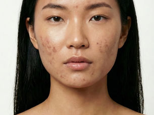 A New Frontier in Acne Treatment: Can “Topical Injections” Transform Oily Skin?