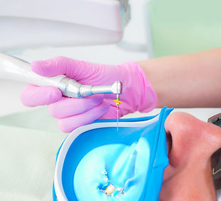 Root Canal Treatment