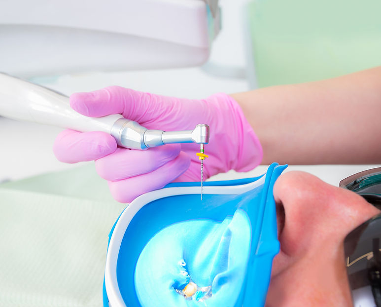 Root Canal Treatment