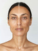 Deray Beauty Güzellik Merkezi Yüz Öncesi ve Sonrası