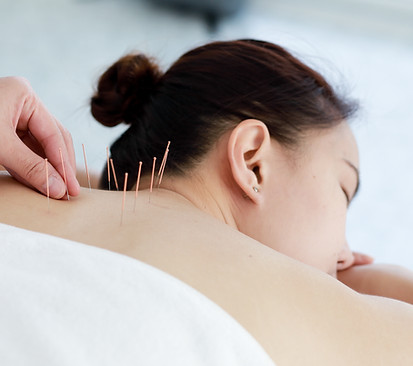 Treating with Acupuncture