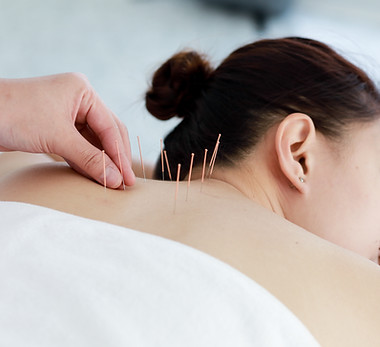 Treating with Acupuncture