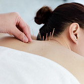 Treating with Acupuncture