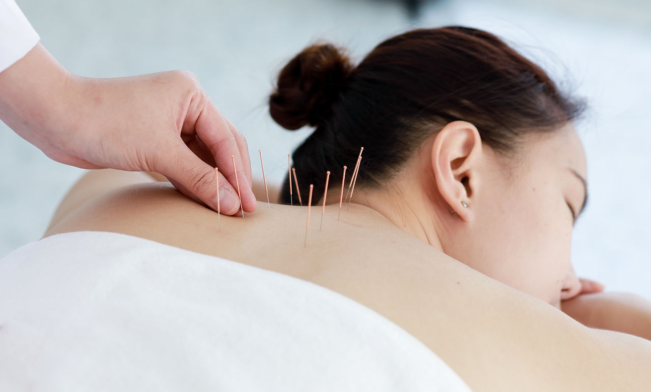 Treating with Acupuncture
