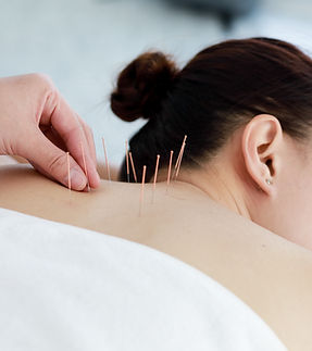 Treating with Acupuncture