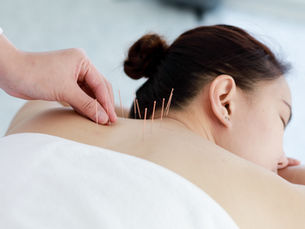 Exploring Myofascial Dry Needling: A Modern Approach to Pain Relief and Healing
