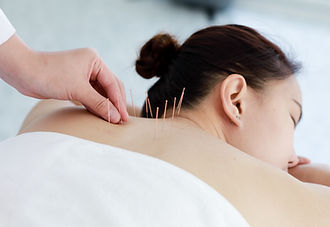 Treating with Acupuncture