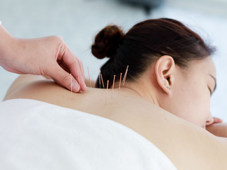 Acupuncture vs. Dry Needling
