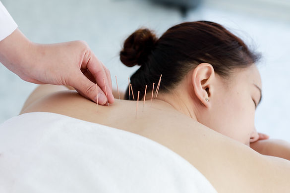 Treating with Acupuncture