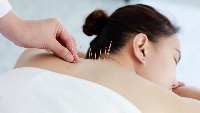 Acupuncture has been used for thousands of years and has become an increasingly common treatment offered by physiotherapists and sports injury clinics. Many runners consider it when dealing with persistent niggles, muscle tightness or longer-term injuries, while others use it as part of a broader recovery routine. Although acupuncture is not a magic solution and should never replace a proper diagnosis or rehabilitation programme, there is evidence that it can help with certain types of pain and may support recovery when used alongside appropriate treatment. If you are considering acupuncture, it should always be carried out by a suitably qualified healthcare professional using sterile, single-use needles. What Is Acupuncture? Acupuncture is a treatment that originated in traditional Chinese medicine. It involves inserting very fine needles into specific points on the body to produce therapeutic effects. Depending on the condition being treated, the needles may sit just beneath the skin or reach deeper into muscle tissue before remaining in place for around 20 to 30 minutes. Modern sports acupuncture often differs from traditional approaches. Many physiotherapists use acupuncture based on Western medical principles, where the aim is to stimulate nerves, muscles and connective tissues rather than influence the flow of energy. Some practitioners combine elements of both approaches depending on the individual and their symptoms. Another commonly used technique is trigger point acupuncture, sometimes referred to as dry needling. This targets tight bands of muscle that can develop through repetitive training, overuse or injury. Releasing these trigger points may reduce pain and improve muscle function for some runners. Why Do Runners Use Acupuncture? Running places repeated stress on muscles, tendons, ligaments and joints. While a sensible training programme, strength work and adequate recovery should always form the foundation of injury prevention, some runners find acupuncture useful as an additional treatment. The most commonly reported benefits include reducing pain, easing muscle tension and supporting recovery following heavy training or injury. Can Acupuncture Help Recovery? One reason runners choose acupuncture is its potential to assist recovery after hard training sessions or injury. Needle stimulation is thought to increase local blood flow, which may help deliver oxygen and nutrients to damaged tissues while removing waste products more efficiently. Improved circulation may support the body's natural healing processes, particularly in muscles and tendons that often receive relatively limited blood supply. Acupuncture may also encourage muscles to relax after demanding training blocks, allowing runners to return to normal movement patterns more quickly. While it should never replace appropriate rest or rehabilitation exercises, it can complement a well-managed recovery plan. Can Acupuncture Help Prevent Running Injuries? Some runners use acupuncture regularly despite not currently being injured. The theory is that reducing muscle tension, improving movement quality and identifying tight areas early may reduce the likelihood of overuse injuries developing. Running involves thousands of repeated strides during every session. Small imbalances can gradually increase stress on certain muscles and tendons, particularly during marathon training when weekly mileage increases significantly. If acupuncture helps maintain normal muscle function and reduces excessive tightness, it may contribute to keeping runners training consistently. However, acupuncture should never be viewed as a substitute for sensible mileage progression, strength training or appropriate recovery, all of which remain far more important for preventing injury. Can Acupuncture Help Muscle Imbalances? Muscle imbalances are common among runners. Tight hip flexors, overloaded calves, restricted glutes or stiff hamstrings can all alter running mechanics and place extra stress elsewhere in the body. These imbalances often develop gradually through repetitive movement. Running the same routes repeatedly, particularly on roads with noticeable cambers, may also place slightly different loads on each side of the body over time. Acupuncture may help reduce excessive muscle tension and improve mobility in affected areas. Combined with strengthening exercises, mobility work and occasional route variation, this may help restore more balanced movement patterns. Can Acupuncture Reduce Stress? Recovery is not just physical. High training loads can also increase mental fatigue and stress levels, particularly when balancing running alongside work and family commitments. Many runners report feeling deeply relaxed during and after acupuncture sessions. Part of this may be linked to the release of endorphins, the body's natural pain-relieving chemicals, while reducing pain itself can also lower overall stress levels. Better relaxation may contribute to improved sleep quality, and consistent good sleep remains one of the most effective recovery tools available to runners. Can Acupuncture Support The Body's Natural Healing? Acupuncture stimulates nerves, muscles and connective tissues, encouraging several biological responses within the body. Research suggests it may promote the release of endorphins while influencing inflammatory responses involved in tissue repair. Some studies have also explored its effects on immune function, although more research is needed to fully understand these mechanisms. For runners recovering from overuse injuries, acupuncture is best viewed as one component of a comprehensive rehabilitation programme rather than a standalone treatment. Are There Any Downsides? Although acupuncture is generally considered very safe when performed by trained professionals, it is not completely risk free. Some people experience minor bruising, temporary soreness or slight bleeding where needles are inserted. Rarely, individuals may feel light-headed during treatment. Anyone with bleeding disorders or certain medical conditions should discuss suitability with their healthcare provider before starting treatment. It is also important to have persistent running injuries properly assessed. Using acupuncture without identifying the underlying cause of pain may delay appropriate treatment if a more significant injury is present. Final Thoughts Acupuncture has become an increasingly accepted treatment within sports medicine and many physiotherapists now include it alongside exercise rehabilitation, manual therapy and strength programmes. Evidence suggests it can help manage some forms of musculoskeletal pain and many runners report positive experiences, particularly when dealing with muscle tightness, tendon problems or longer-term overuse injuries. However, responses vary between individuals and it should not be seen as a cure for every running injury. The best approach is to think of acupuncture as another tool rather than the entire toolbox. Consistent training, gradual mileage progression, appropriate strength work, good nutrition, quality sleep and sensible recovery will always have the biggest influence on staying healthy. When used alongside these foundations and delivered by a qualified practitioner, acupuncture may provide an additional boost that helps keep you running comfortably.