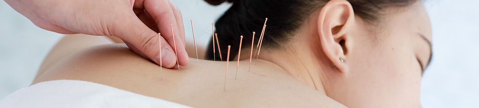 Treating with Acupuncture