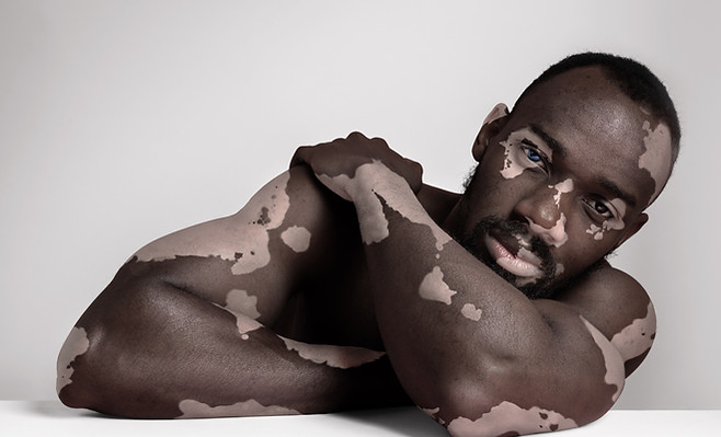 Male with Skin Discoloration with Confidence