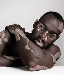 Homme atteint de vitiligo