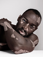 Man with Vitiligo