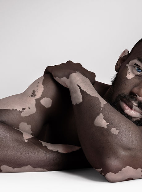 Beauty in Pigmentation