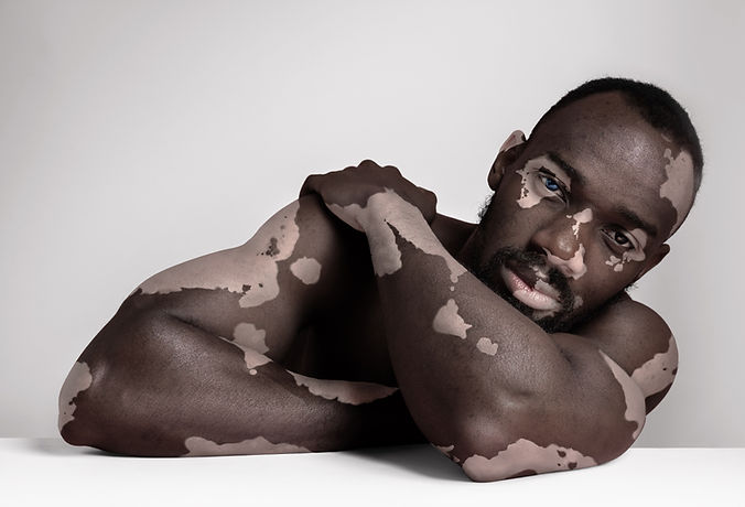 Beauty in Pigmentation