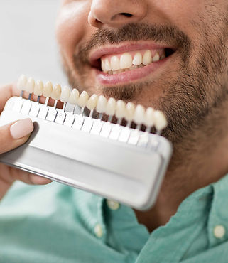 Teeth Shade Matching