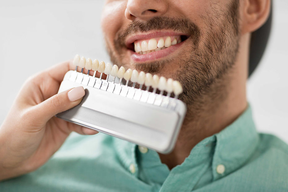 Teeth Shade Matching