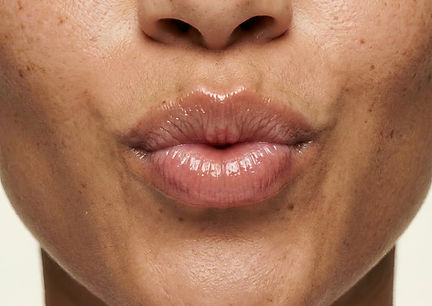 DERMAL FILLERS