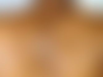 a woman who had cherry angiomas removed at Laser & Skin Belfast