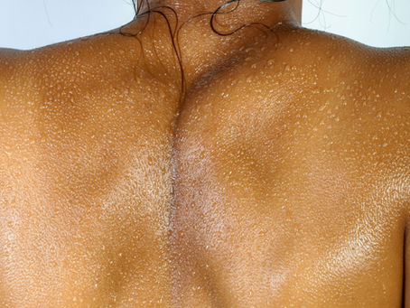 a woman who had cherry angiomas removed at Laser & Skin Belfast