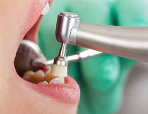 Dental Cleaning