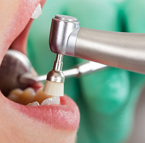 Dental Cleaning