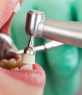 Dental Cleaning - scale and polish