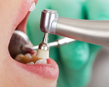 Dental Cleaning Procedure