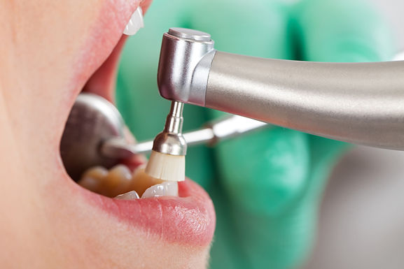 Dental Cleaning Procedure