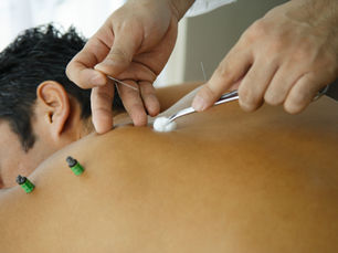 Kuru İğneleme Rehberi: İğne Boyutları ve Seçenekleri