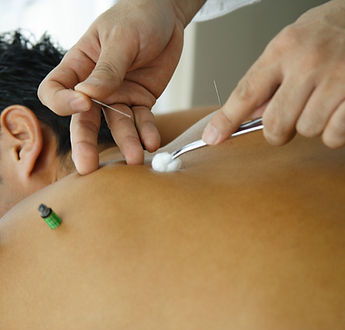 Acupuncture Session