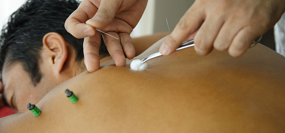 Doctor placing acupuncture needles into man's back