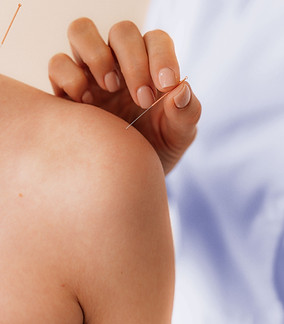 Acupuncture Needle on Shoulder
