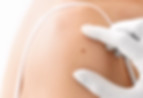 Skin Imperfection Removal Including Skin Tags and Milia Trowbridge Skin Care Clinic