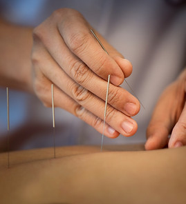 Gros plan sur l'acupuncture
