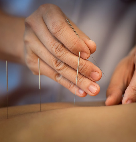 Acupuncture Close Up