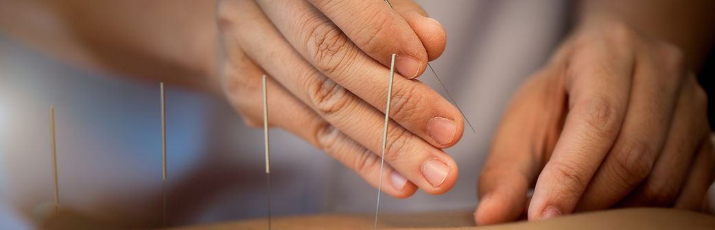 Acupuncture Procedure
