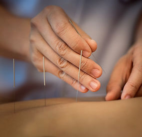 Acupuncture Close Up
