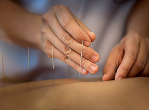 Acupuncture Procedure