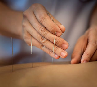 Acupuncture Close Up