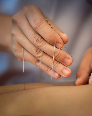 Acupuncture Close Up
