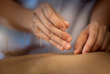 Acupuncture Ubud