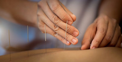 Acupuncture Procedure
