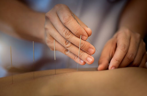 Acupuncture treatment with fine needles