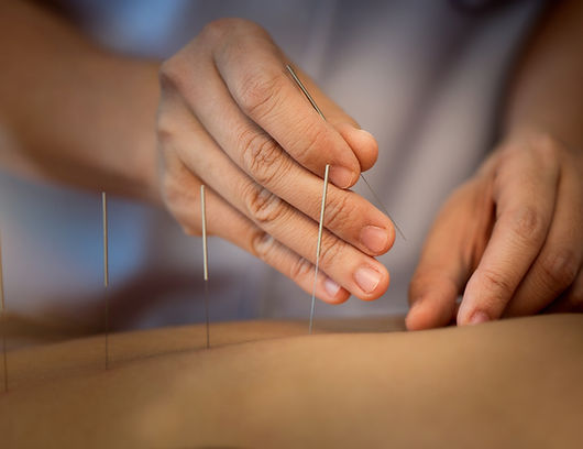 Acupuncture Close Up