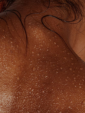 Picture of woman with excessive sweating or hyperhidrosis for treatment with Safe Medical-grade botulinum toxin treatment at DermaSculpt Toronto by Nurse Practitioners