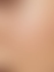 Professional dermaplaning treatment being performed at Clinic4O2 in Takanini, Auckland